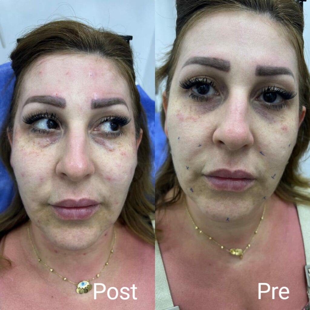 حقن سكلبترا قبل وبعد